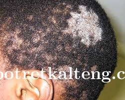 Usai Ditangani RSUD Dr Doris Slyvanus, Kondisi Laura Penderita Infeksi Jamur Dikepala Mulai Membaik